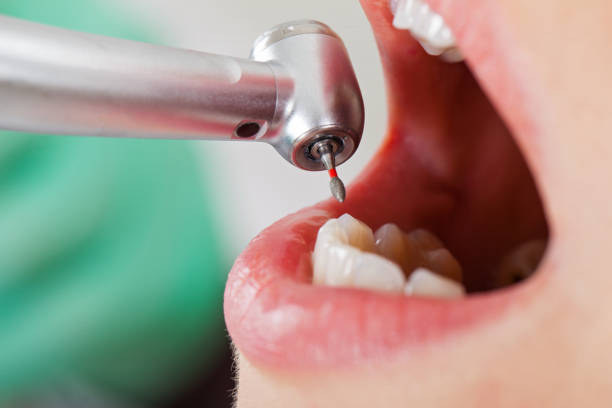 Best Emergency Root Canal Treatment in Delano, CA